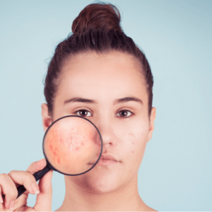 Descubra soluções caseiras para o tratamento da acne