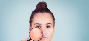 Descubra soluções caseiras para o tratamento da acne